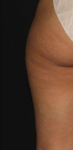 Coolsculpting to Inner & Outer Thighs After